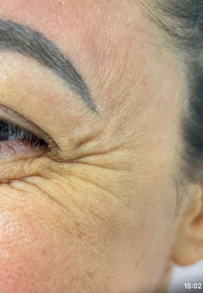 Rosto com rugas marcantes