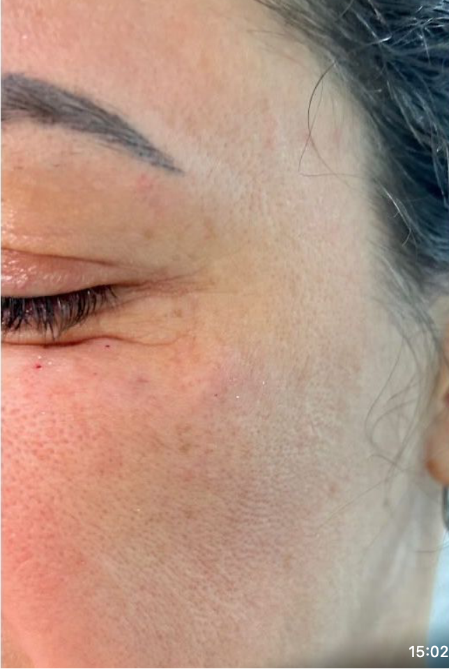 Rosto após tratamento